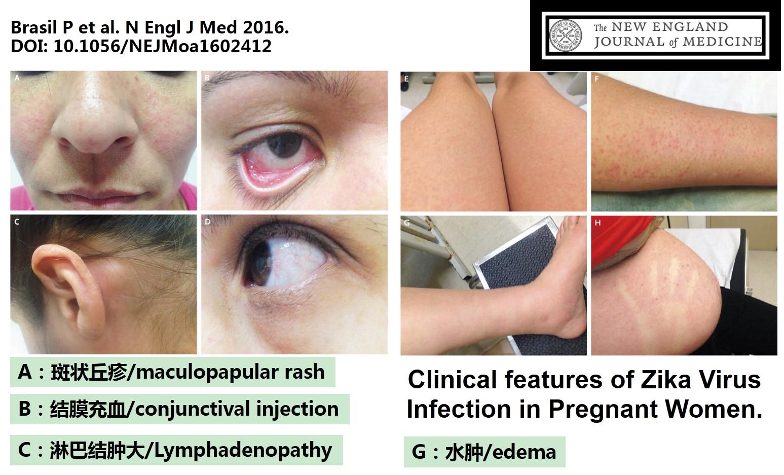 寨卡病毒对青少年危害 寨卡病毒如何影响男性健康