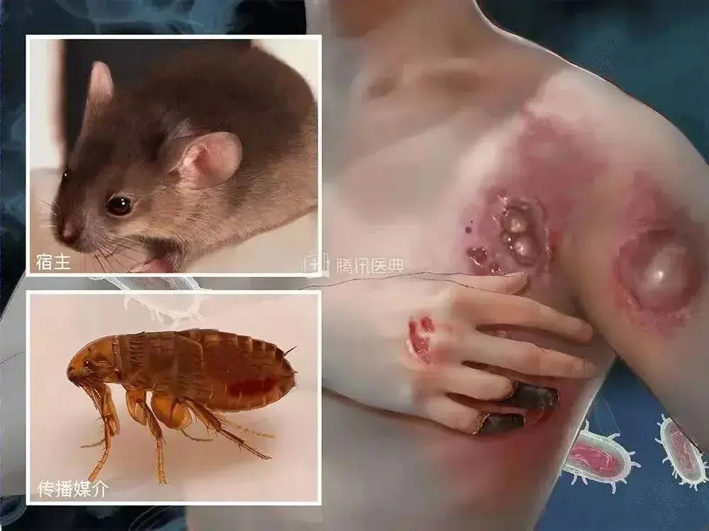 鼠疫为什么叫黑死病 鼠疫的传播方式与症状详解