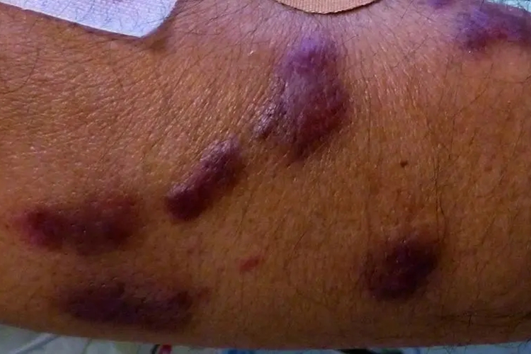 我的“小头症”儿子今年53岁，寨卡病毒有多毒？...