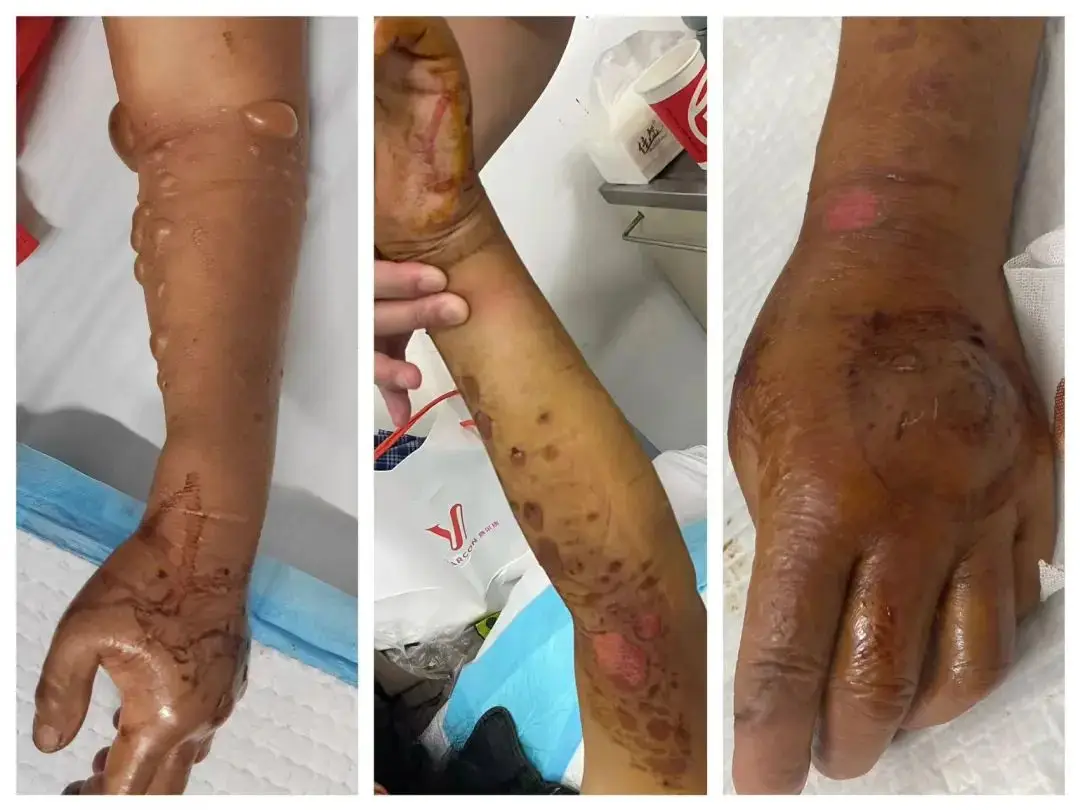 全球最毒蛇类盘点 人被毒蛇咬伤能活多久